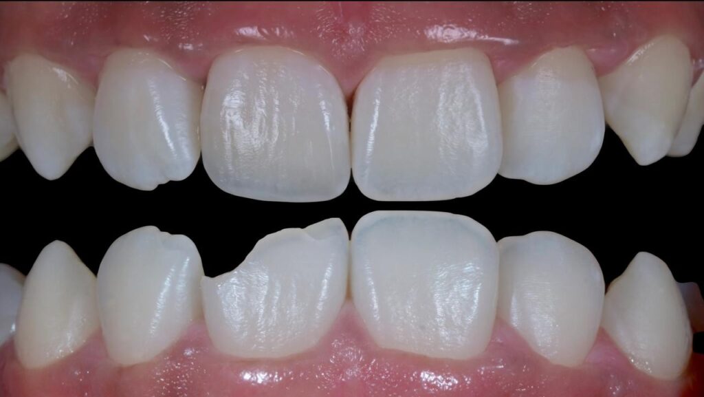 Close-up image highlighting a chipped lower incisor, ideal for illustrating clinical techniques in anterior and posterior composite restoration during a CPD course