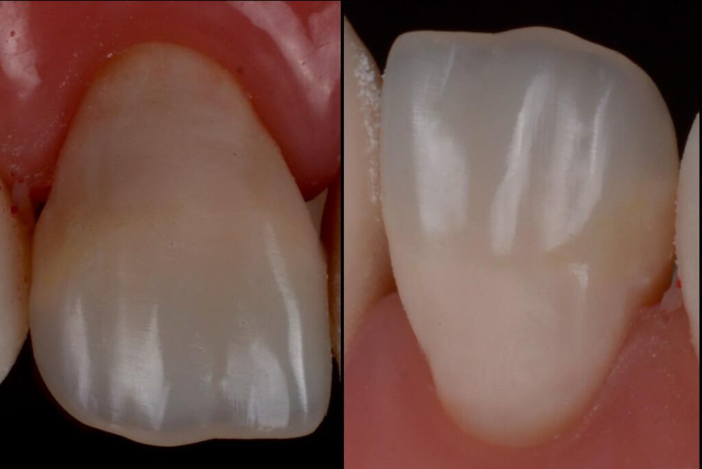 Side-by-side close-up images showing two natural, healthy teeth with surrounding gum tissue—ideal for demonstrating subtle aesthetic differences or material blending in anterior and posterior composite restorations